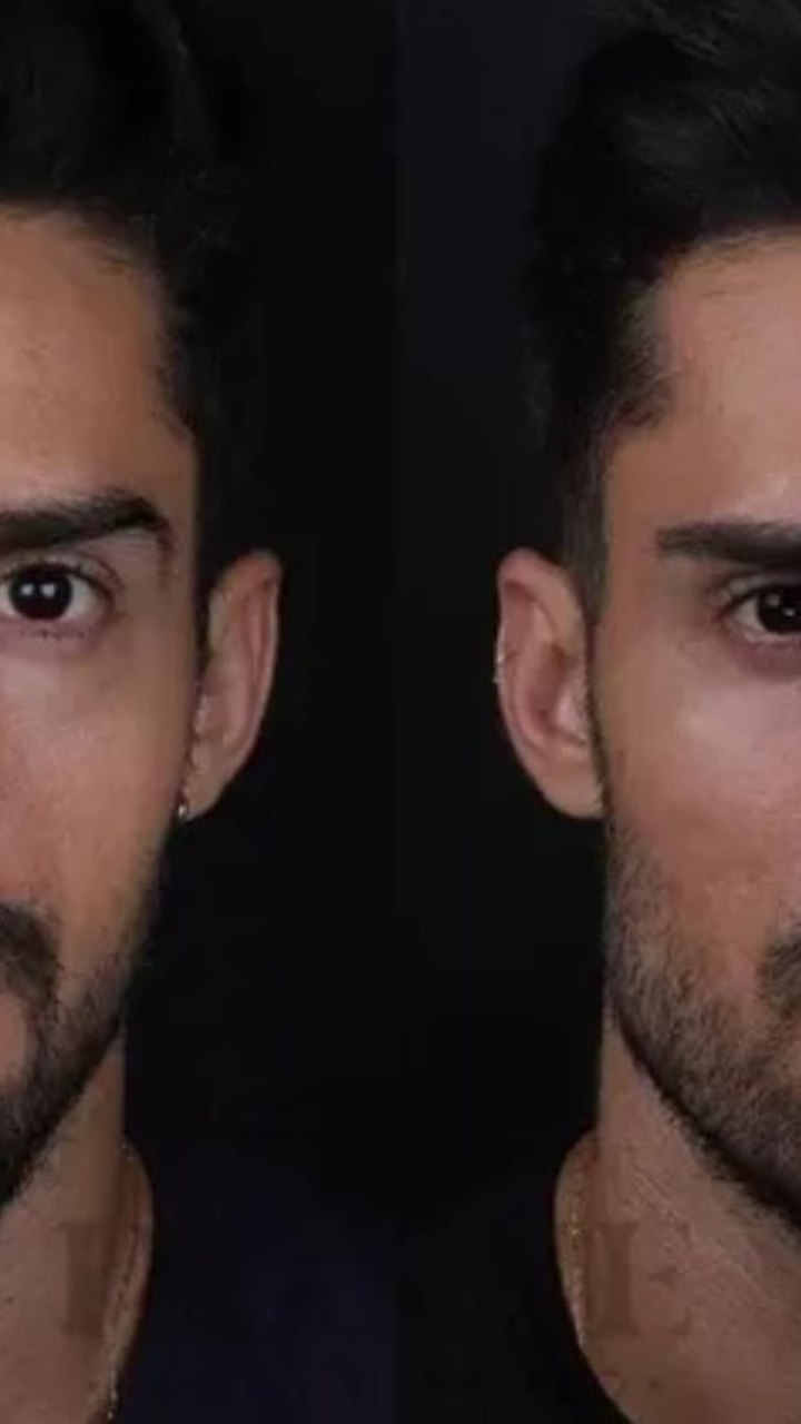 Guilherme Leicam faz harmonização facial e botox no rosto todo