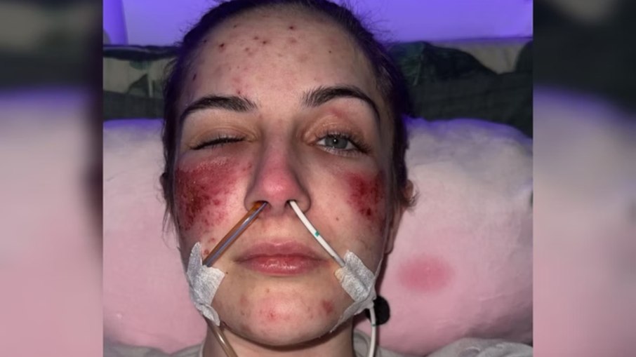Jovem enfrenta doença rara que causa queimaduras quando ri Jovem enfrenta doença rara que causa queimaduras quando ri