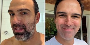 Ana Maria pressiona e Tadeu Schmidt admite implante capilar