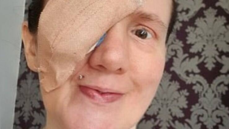 Jovem mulher com doença de Hordéolo no olho, Banco de Video - Envato  Elements