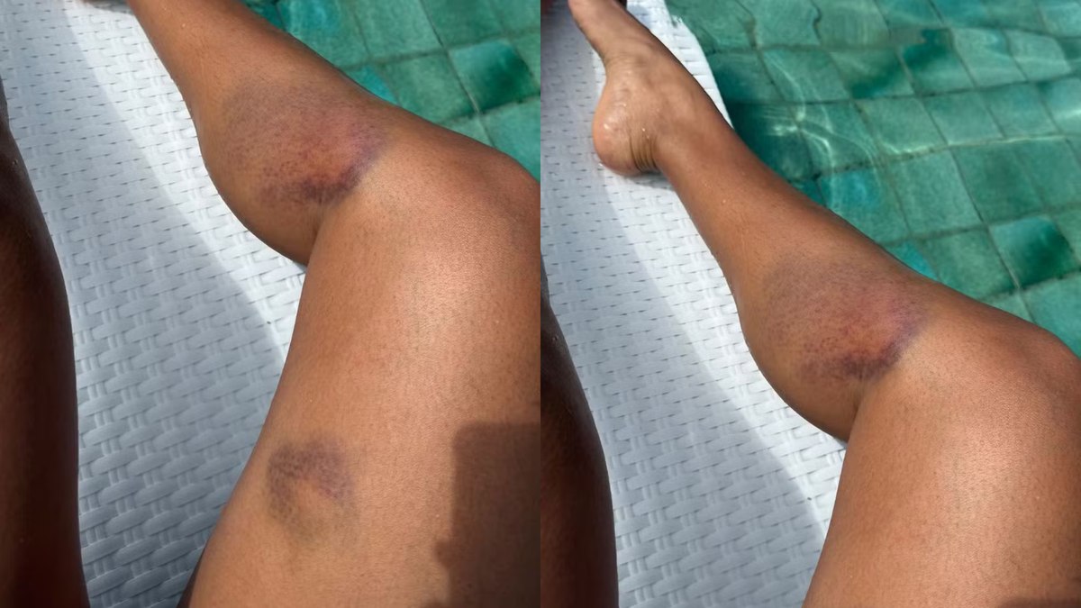 Sheron Menezzes mostra hematomas