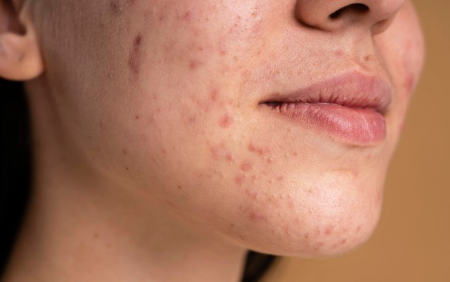 O que é Roacutan, quem pode tomar e como o remédio age na pele com acne?