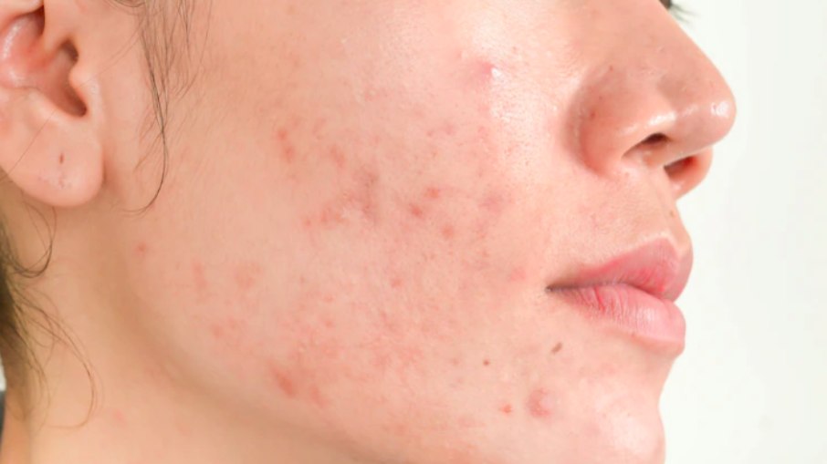 Cicatriz de acne: como resolver?