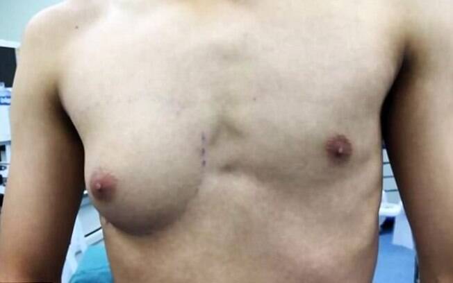 Garoto que sofria de ginecomastia desde os 13 anos teve apenas um peito desenvolvido