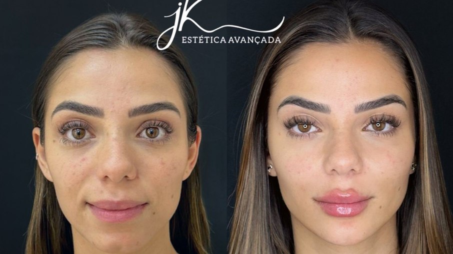 Keyt Alves, irmã da ex-BBB 23 Key Alves, realizou harmonização facial