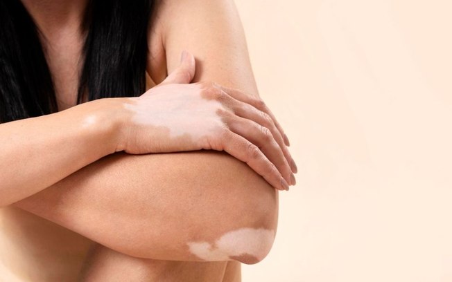 Convivendo com o vitiligo: condição pede cuidados específicos Convivendo com o vitiligo: condição pede cuidados específicos