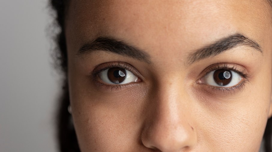 Olheiras na pele negra: causas, tratamentos e prevenção