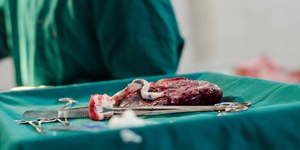 Comer placenta tem benefícios? Médica explica