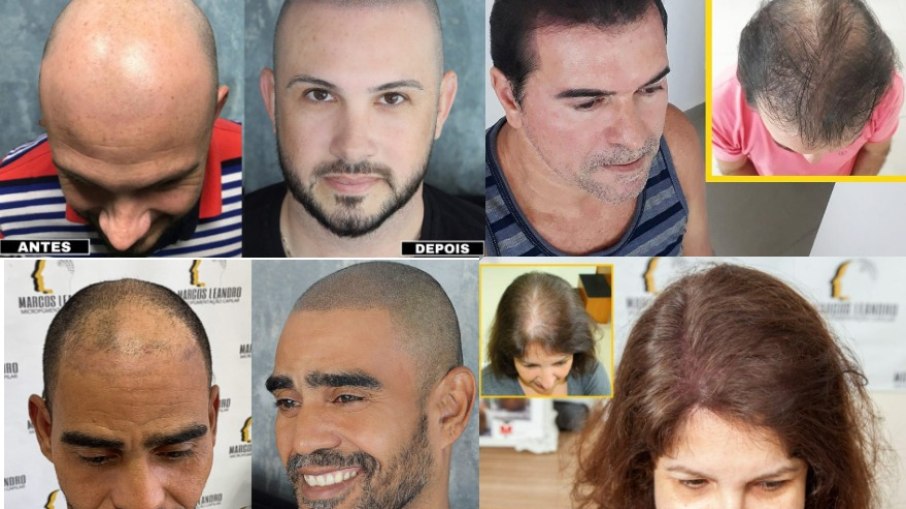 Especialista e criador da técnica 4D, Marcos Leandro ajuda a reconstruir o aspecto visual capilar de pessoas que sofrem com problemas como calvície, alopecia e cicatrizes