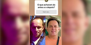 Marido de Gretchen impressiona com antes e depois de transformação facial; veja detalhes