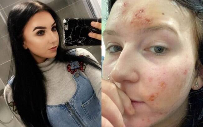 A britânica Natasha Martlew sofreu uma queimadura química no rosto após utilizar um produto com ácido salicílico 