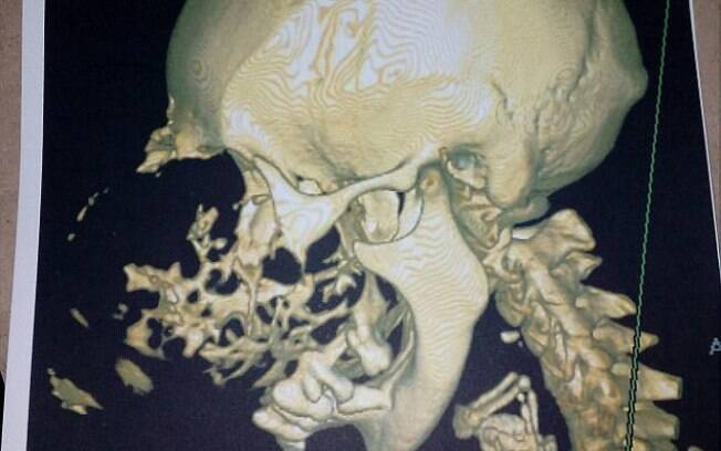 Ao realizar exames de imagem, foi possível constatar que diversos ossos da face da idosa foram quebrados com o crescimento do tumor Ao realizar exames de imagem, foi possível constatar que diversos ossos da face da idosa foram quebrados com o crescimento do tumor