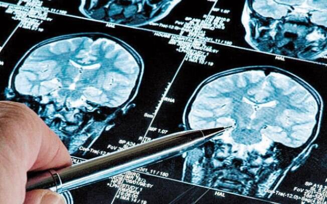 Pesquisadores encontram relação entre gengivite e Alzheimer