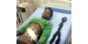 Jovem descobre que carregava o próprio gêmeo dentro do corpo