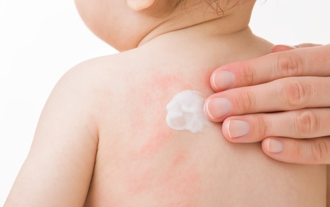 Creme para assadura de bebê: 5 opções para prevenir e tratar irritações na pele