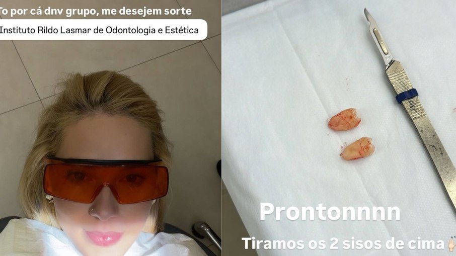 Virginia passa por cirurgia para a retirada dos sisos após sofrer com fortes dores por dois dias.