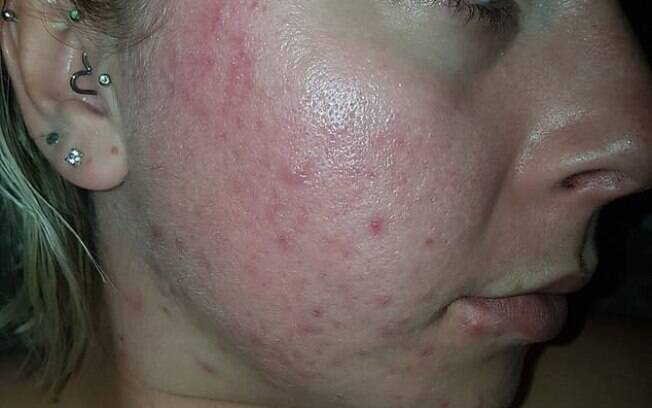 A britânica Emily McClarron que sofre de acne severa encontrou solução na A britânica Emily McClarron que sofre de acne severa encontrou solução na