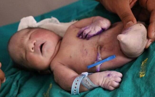 Bebê com síndrome da sereia morre após 15 minutos do nascimento; condição rara foi descoberta após o parto da criança