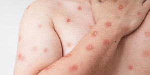 Paraná confirma primeiro caso de Mpox: quais os riscos do vírus?