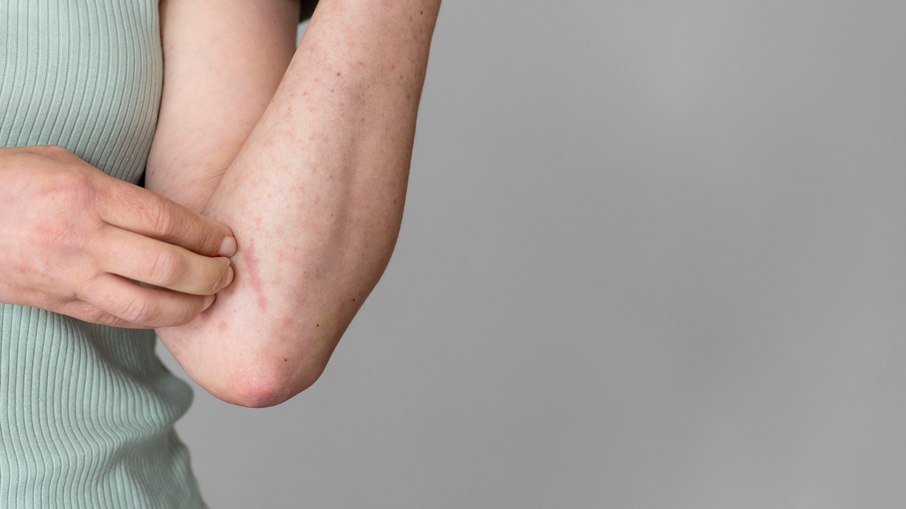 Alergia de pele