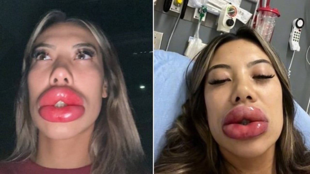 Basia Query viralizou no TikTok ao postar um vídeo em que aparece com os lábios extremamente inchados