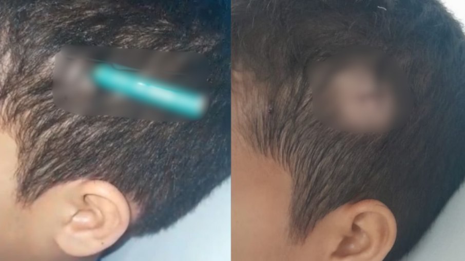 Aluno tem lápis cravado na cabeça por colega de classe