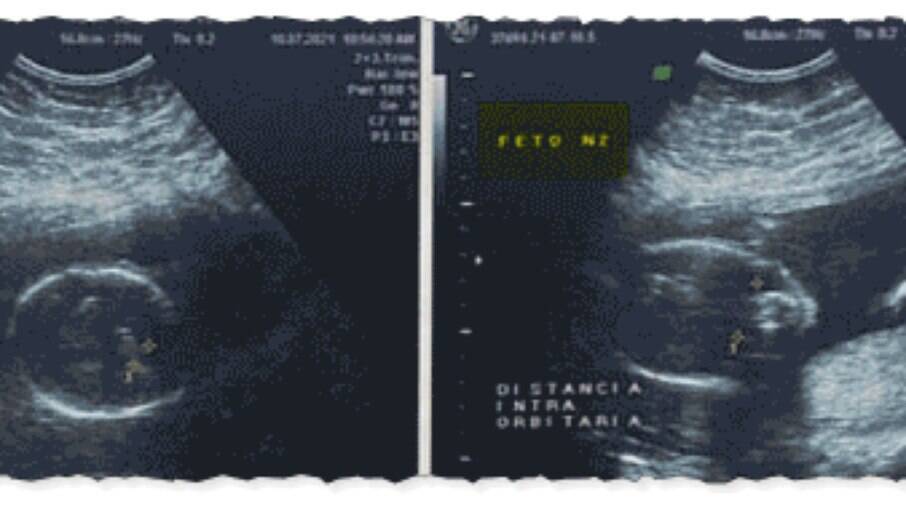 Exame de ultrassom mostra dois fetos
