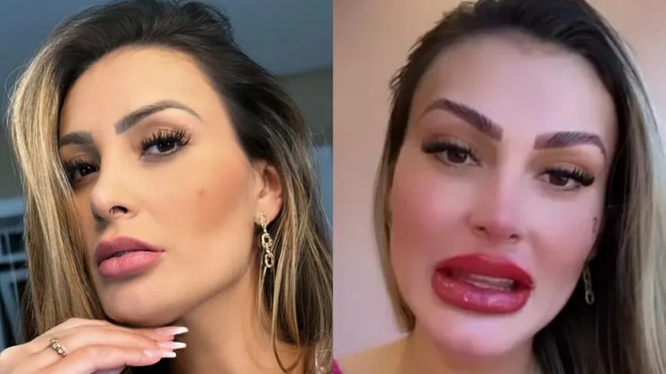 Andressa Urach realiza preenchimento labial e reflete sobre investimento na aparência
