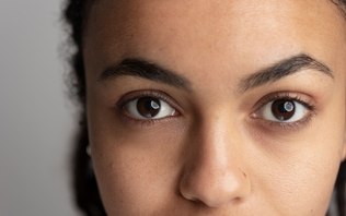 Olheiras na pele negra: causas, tratamentos e prevenção