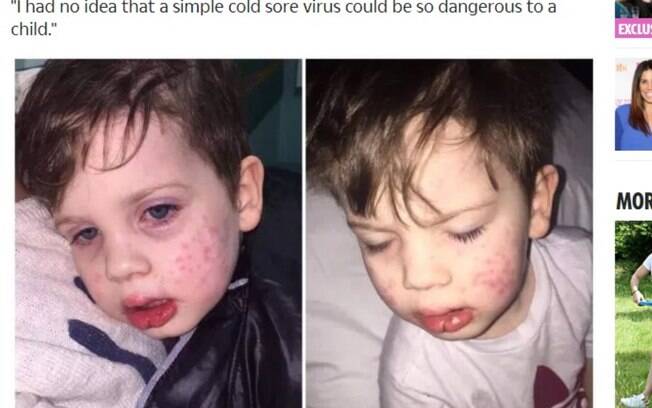 Erupções cutâneas foram os sinais de herpes no menino de três anos; vírus possivelmente foi passado por beijo