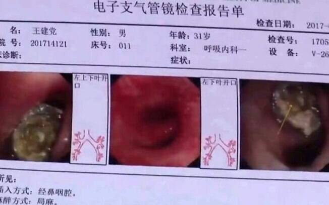 Exames mostram a tampa da caneta no pulmão de Wang