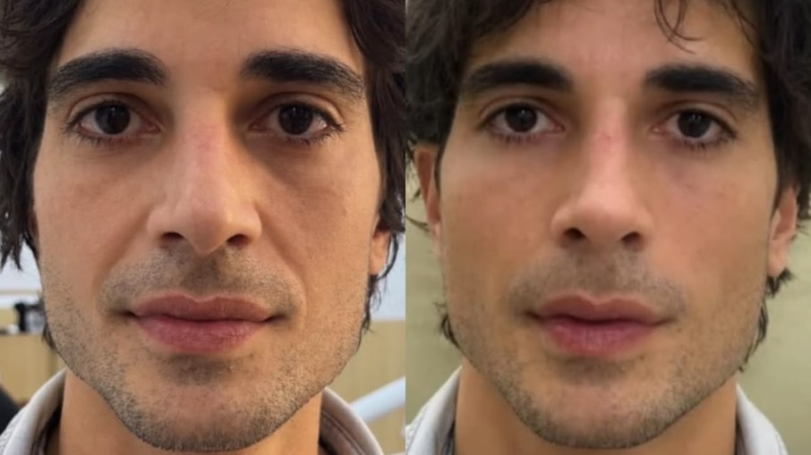 Fiuk faz harmonização facial no SBT e surpreende com resultado Fiuk faz harmonização facial no SBT e surpreende com resultado