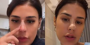Simone Mendes nega cirurgia ao aparecer com nariz diferente