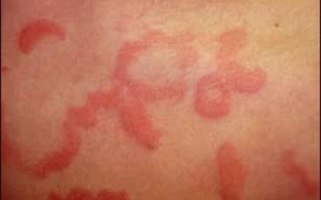 A doença pode se manifestar em qualquer parte do corpo, na forma de manchas avermelhadas e vergões
