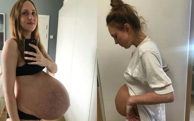 Mãe de trigêmeos mostra como ficou sua barriga após dar à luz aos filhos por meio de uma cesariana