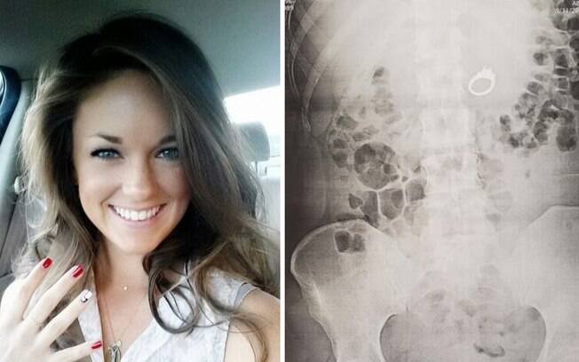 Jenna Evans, noiva de Bob Howell, precisou passar por um procedimento no hospital para retirar o anel do estômago