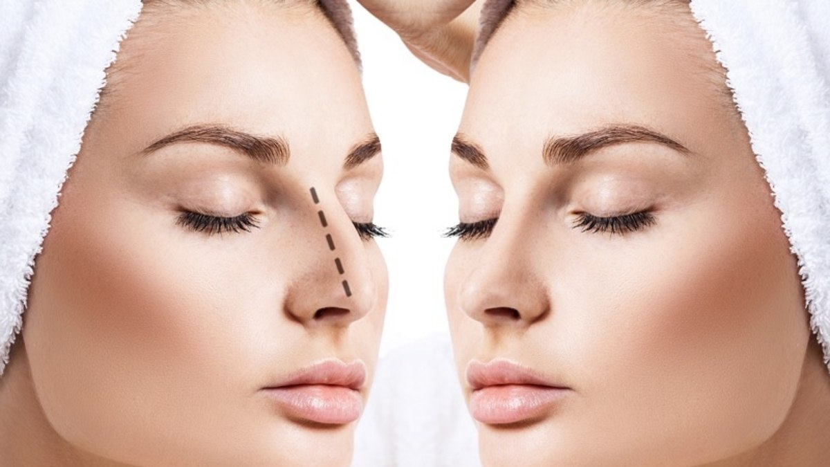 Rinoplastia estruturada combina remodelação da forma com preservação da função respiratória Rinoplastia estruturada combina remodelação da forma com preservação da função respiratória