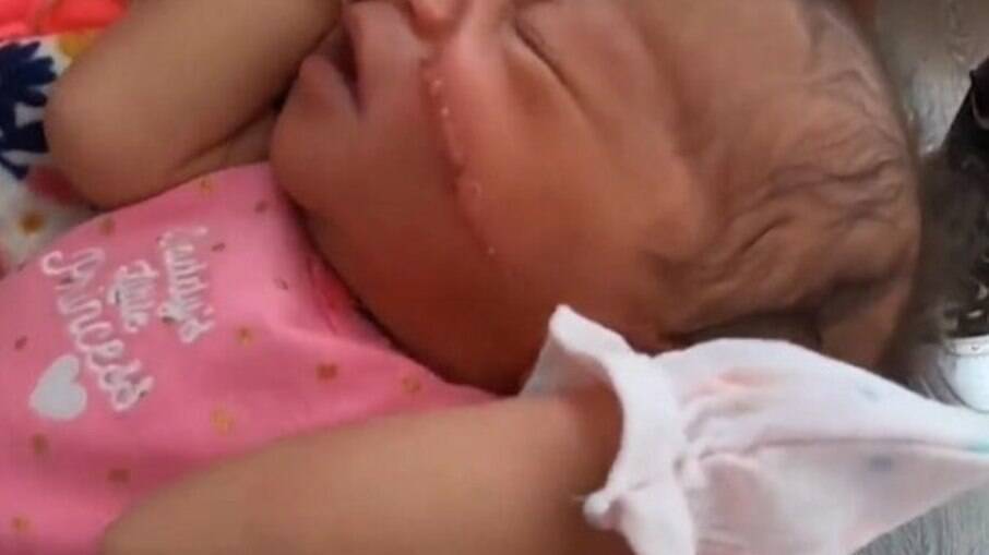 Bebê tem o rosto cortado em cesárea