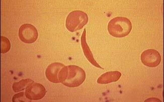 Doença falciforme acontece quando os glóbulos vermelhos assumem o formato de foice por conta de distúrbios hereditários Doença falciforme acontece quando os glóbulos vermelhos assumem o formato de foice por conta de distúrbios hereditários