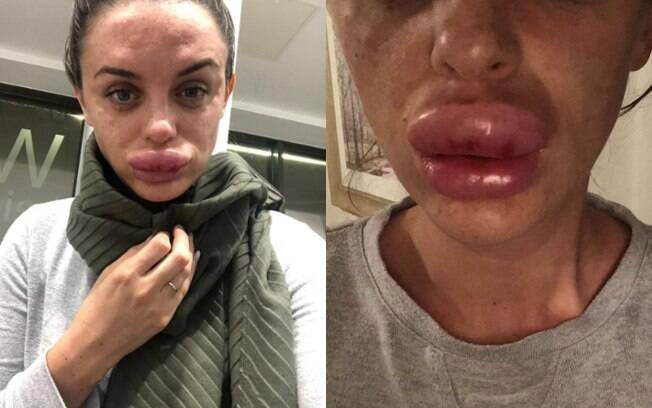 Rachael Knappier fez preenchimento labial, mas procedimento deu errado e seu lábio ficou quatro vezes maior que o normal 