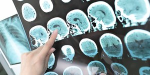 Esclerose múltipla: avanços tornam diagnóstico mais preciso