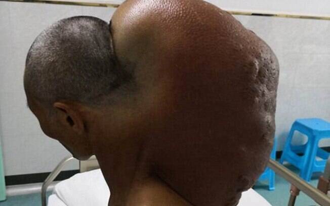 A massa retirada do pescoço de Xingfu pesava cerca de 15 quilos, segundo os especialistas A massa retirada do pescoço de Xingfu pesava cerca de 15 quilos, segundo os especialistas