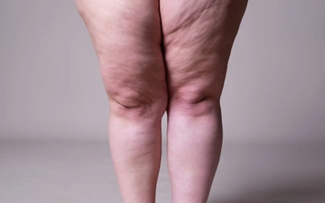 Rennova® apresenta soluções para compor protocolos integrados e individualizados para pacientes com lipedema