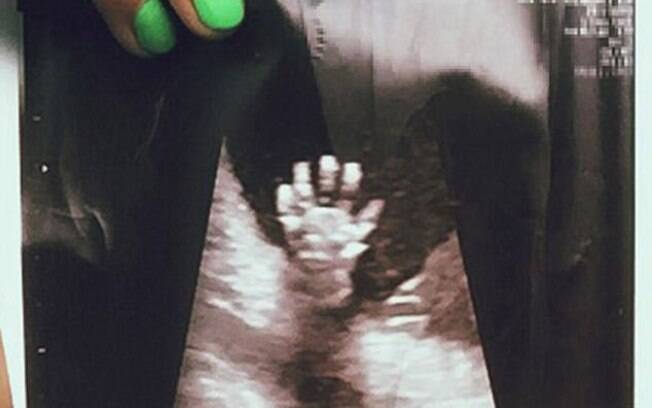 Ultrassom mostra bebê fazendo 