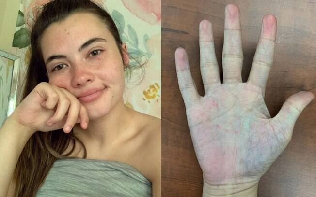A universitária conta como descobriu a doença, aos 10 anos, após a pele ficar irritada enquanto tomava banho