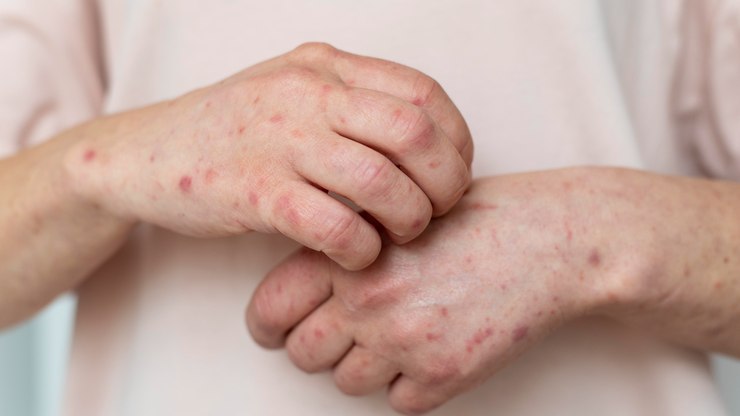 Casos de Mpox chegam a 149 em 2026 e acendem alerta sanitário