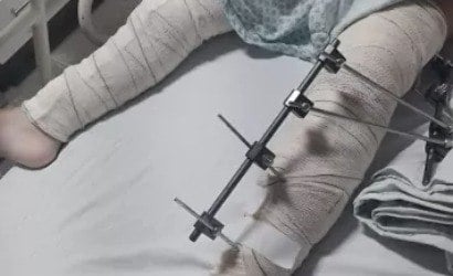 Médicos operam perna errada de menina de 6 anos