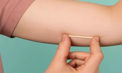 Planos de saúde terão cobertura para implante hormonal
