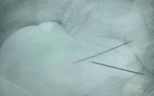 As agulhas foram enfiadas na barriga há 66 anos e causaram uma condição chamada fístula enterocutânea As agulhas foram enfiadas na barriga há 66 anos e causaram uma condição chamada fístula enterocutânea