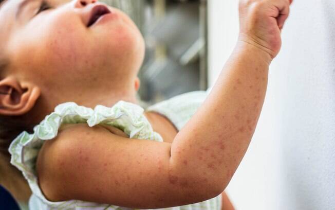 Governo oferece a vacina contra sarampo gratuitamente e faz parte do Calendário Nacional de Vacinação